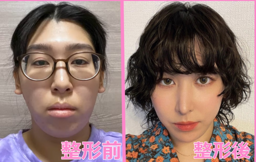 ゆめっちの整形・前後の画像比較！整形前と整形後！方法！動画！高校生の頃の写真！鼻フックNG！お笑いトリオ・3時のヒロインのゆめっち ...